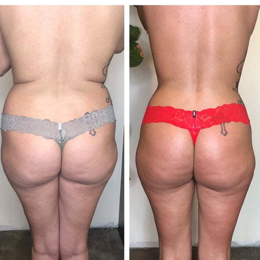Wood Therapy Results & What You Can Expect!